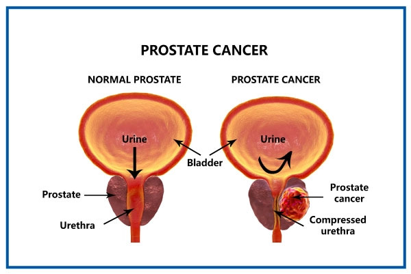 What Is Prostate Cancer